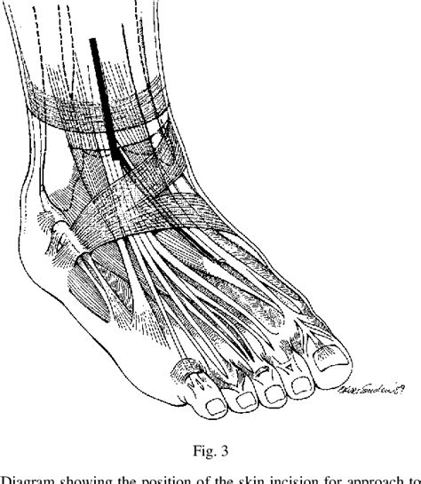 Figure 3 from Extensor retinaculum syndrome of the ankle after injury to the distal tibial ...