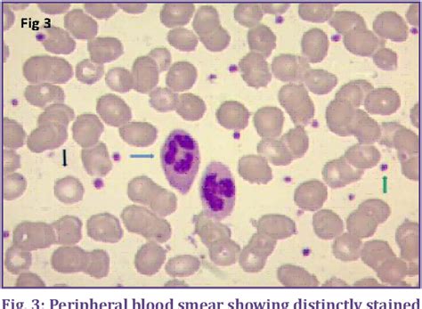 Figure 1 from A Study of Rapid Leishman Stain on Peripheral Blood Smear ...