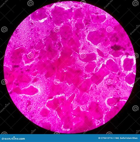 Sputum Smear Under Microscopy Showing Gram Positive Cocci Bacteria Stock Photo - Image of ...