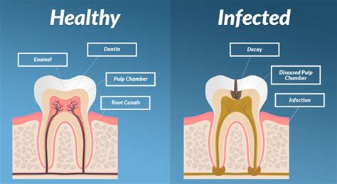 Symptoms of Tooth Infection Spreading to Body