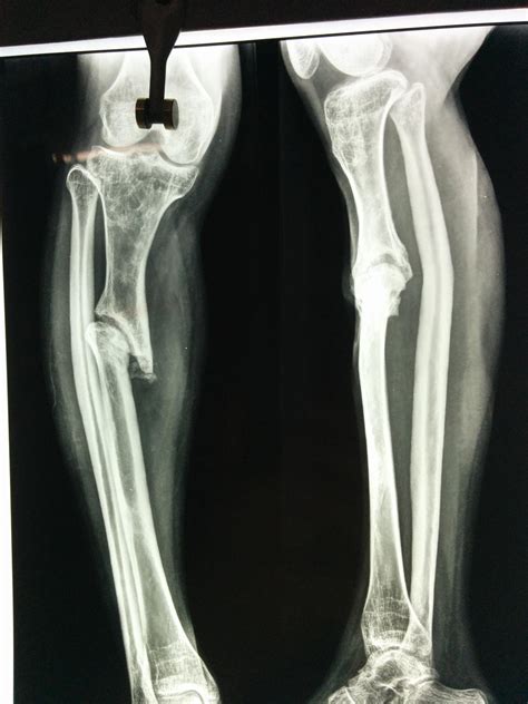 Proximal Third Tibia Fracture - Trauma - Orthobullets