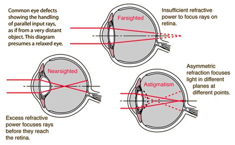 Common Eye Defects