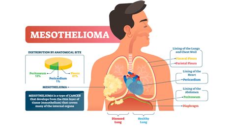 What Is Mesothelioma? - Laws101.com