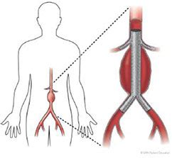 My Surgery: Endovascular Aneurysm Repair (EVAR)