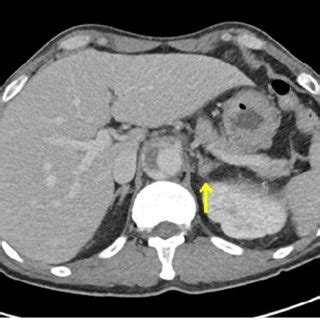 (A) Adrenal gland computed tomography (CT) (unenhanced phase). Arrow ...