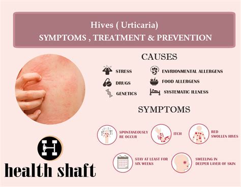 Hives (Urticaria) : Causes, types, symptoms, treatment and prevention - Health Shaft