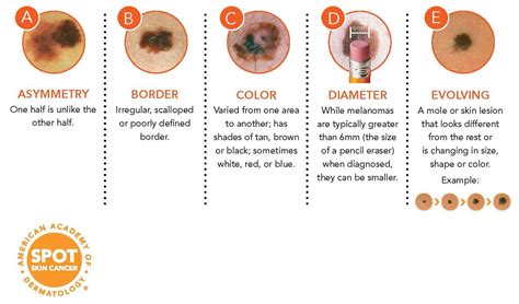 Annual Skin Cancer Screening Dermatologist Spring Texas | Houston | Katy