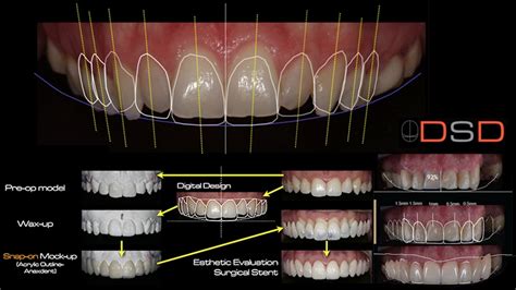 Smile Makeover Design at Mona Vale Dental