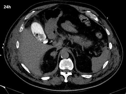 Vicarious contrast media excretion | Radiology Reference Article | Radiopaedia.org