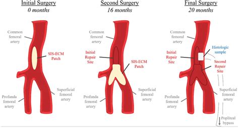 Schematic representation of repeated iliofemoral endarterectomies in... | Download Scientific ...