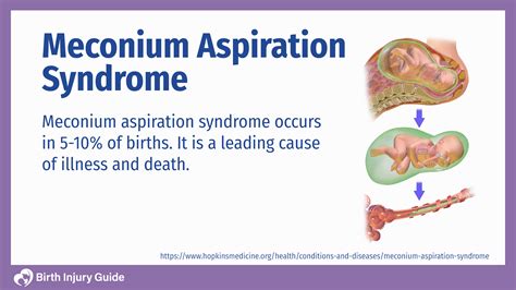 Meconium Aspiration Syndrome (MAS) | Birth Injury Guide