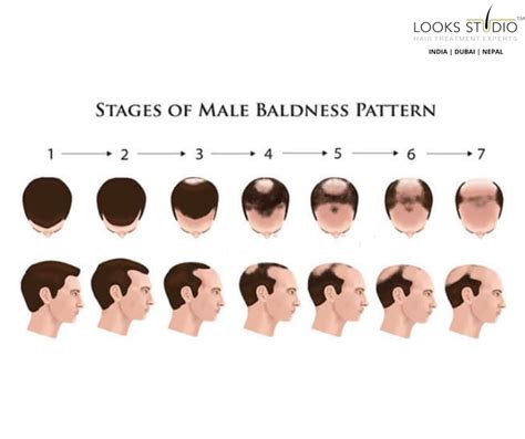 Balding Progression