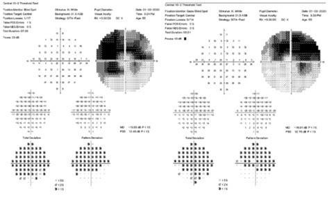 Dr. Noskow's Case Report | Plaquenil Toxicity - Hollywood Eye Institute