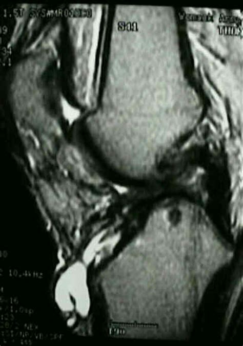 Complications of ACL Reconstructions : Wheeless' Textbook of Orthopaedics