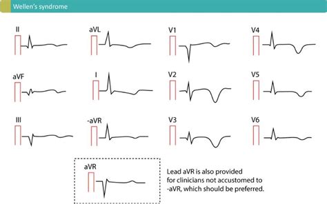 Pin on ECG