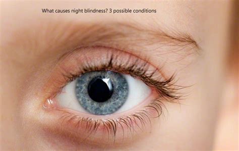 Heath Care: What causes night blindness? 3 possible conditions