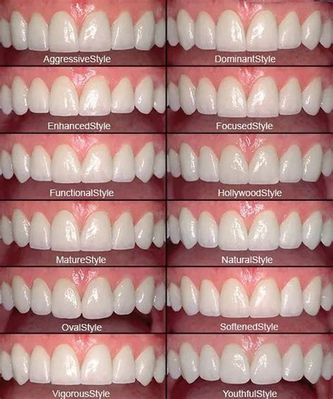 Veneers vs Crowns: Which Option is Best for You? | Sarasota Dentistry ...