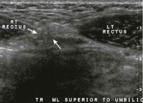 Epigastric linea alba hernia: appears on transverse view as a small,... | Download Scientific ...