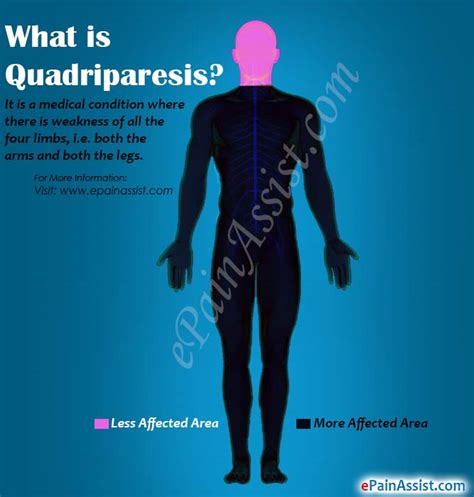 Quadriparesis|Causes|Symptoms|Treatment|Diagnosis