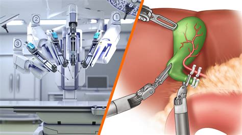 Robotic in Cholecystectomy Surgery By Dr. Saurabh Kalia - Dr Saurabh Kalia