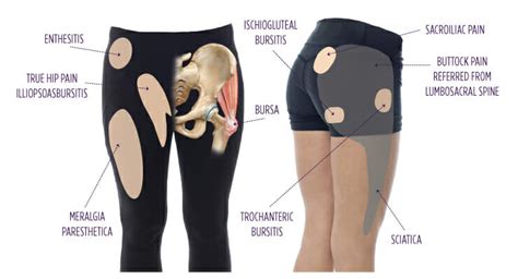 What is Trochanteric Bursitis? | Summit Orthopedics | Trochanteric ...