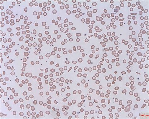 Acute Hemolytic Transfusion Reaction - JETem