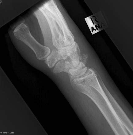 Triquetral fracture | Radiology Reference Article | Radiopaedia.org