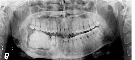 Radiopaque Mandibular Lesions