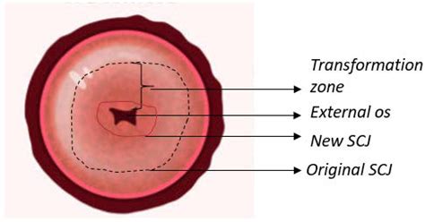 Cervical Imaging in the Low Resource Setting | Encyclopedia MDPI