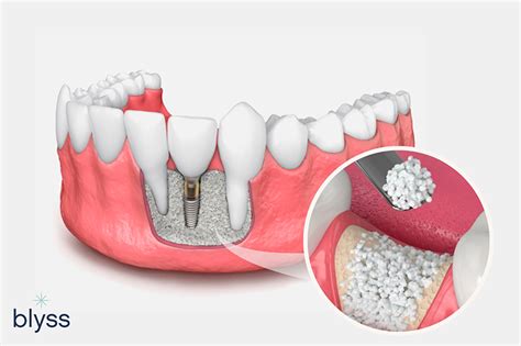 Dentist Answers Top 12 Dental Bone Grafting Questions - Blyss Dental