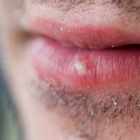 Relieving Pain From Sun Blisters on Lips | HowStuffWorks