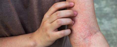 Blanching Rash: Causes and Treatments in Adults and Children