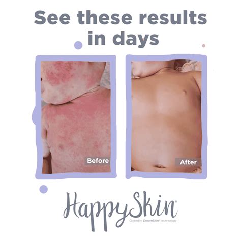 Alternative to steroid cream for Eczema | HappySkin