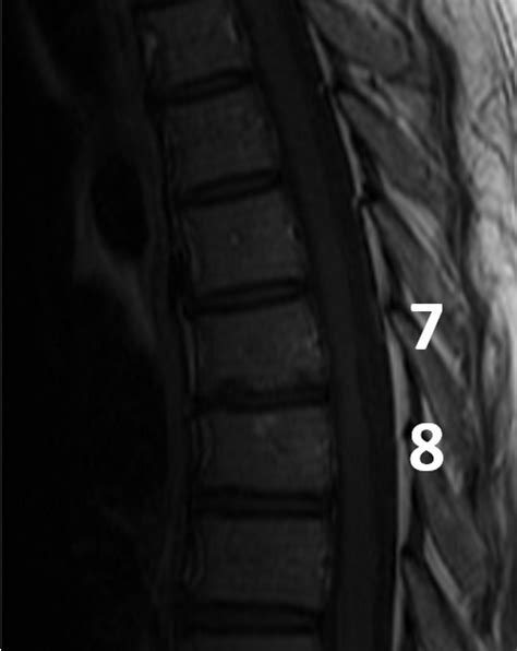 Multiple Sclerosis (MS) of the Spine - MRI Online