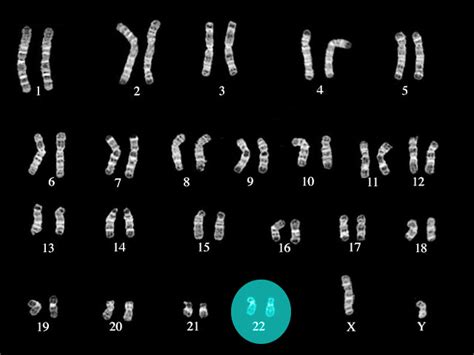 [Figure, DiGeorge syndrome karyotype Image courtesy O Chaigasame ...