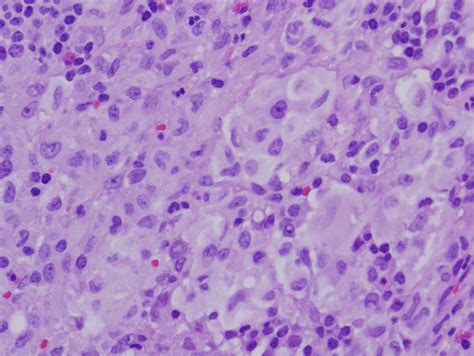 Pulmonary Langerhans Cell Histiocytosis Histology - cloudshareinfo