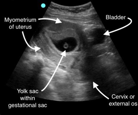 Ultrasound First Trimester Of Pregnancy