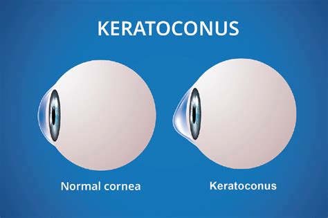 MillennialEYE | Severe Keratoconus and IOL Calculations