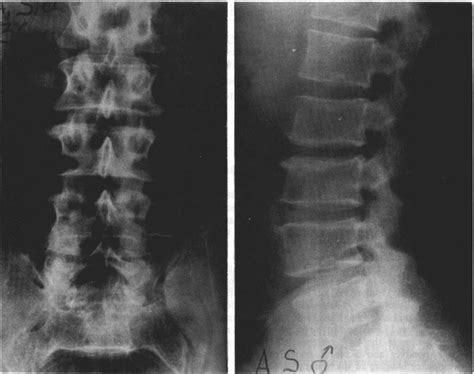 Lumbar spine X-rays demonstrating spinal canal stenosis. | Download Scientific Diagram