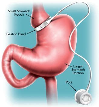 Band and Port Complications after Adjustable Gastric Banding | Dr. Sharma's Obesity Notes