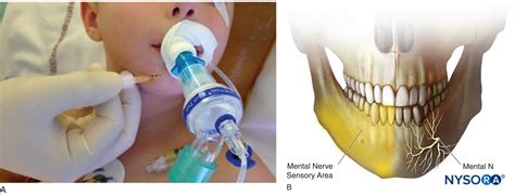 regional-anesthesia-mental-nerve-block-sensory-area-of-the-mental-nerve - NYSORA | NYSORA