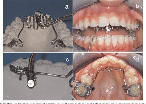 Figure 2 from Tongue pressure changes before, during and after crib ...