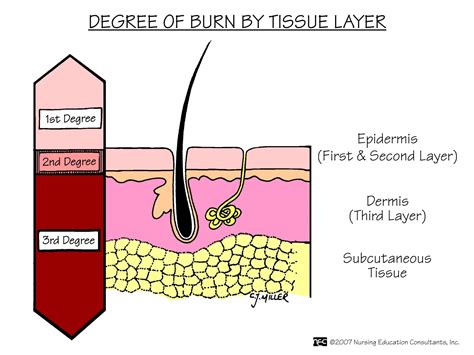 First Degree Burn Diagram