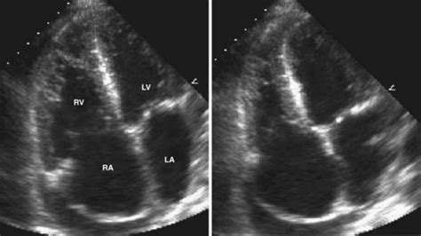 Echocardiography in the Patient with Right Heart Failure | Clinical Gate