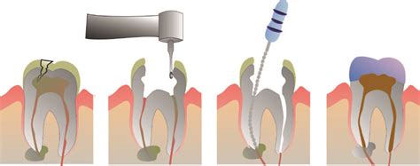 Endodoncia - Clinica Dental Los Arroyos