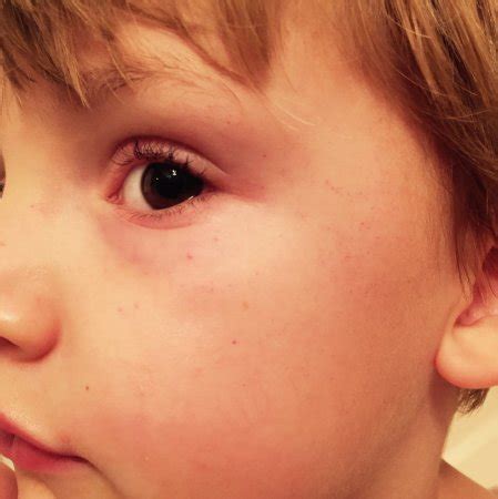 Petechiae? - BabyCenter