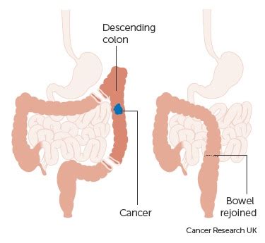 Colectomy - The Operative Review Of Surgery