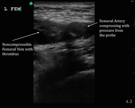 Massive DVT | Emory School of Medicine