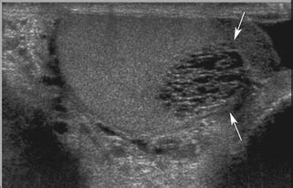 Mediastinum Testis Ultrasound