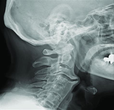 Cervical Osteophytes